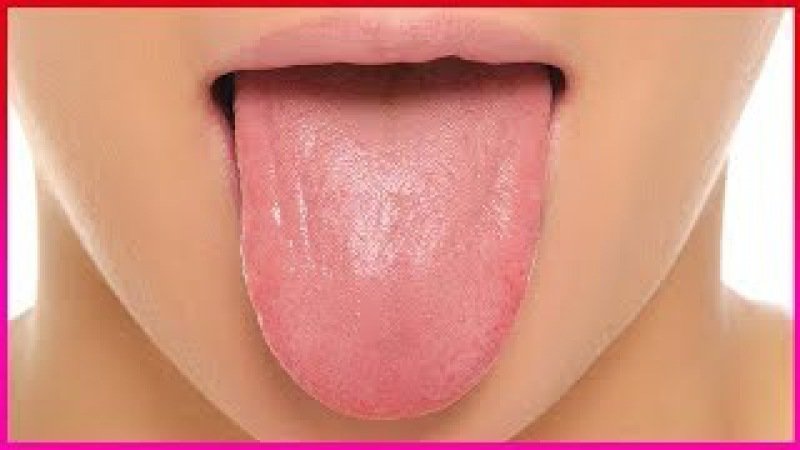 Гипопластический глоссит