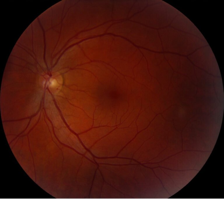 Отслойка сетчатки глазное дно