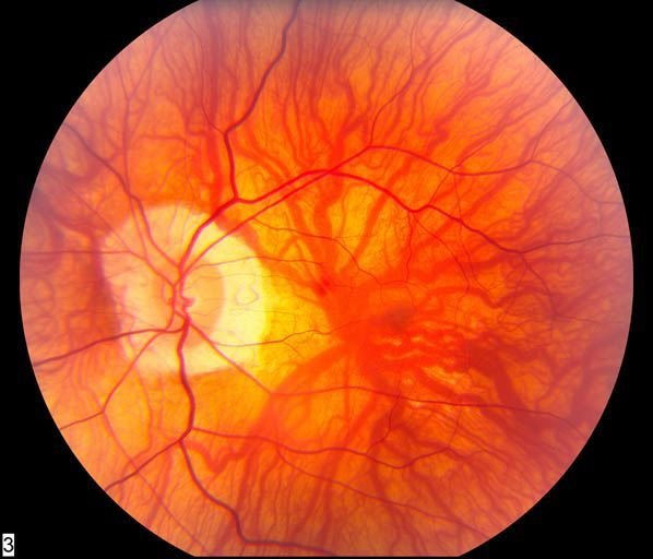 Миопическая дегенерация сетчатки