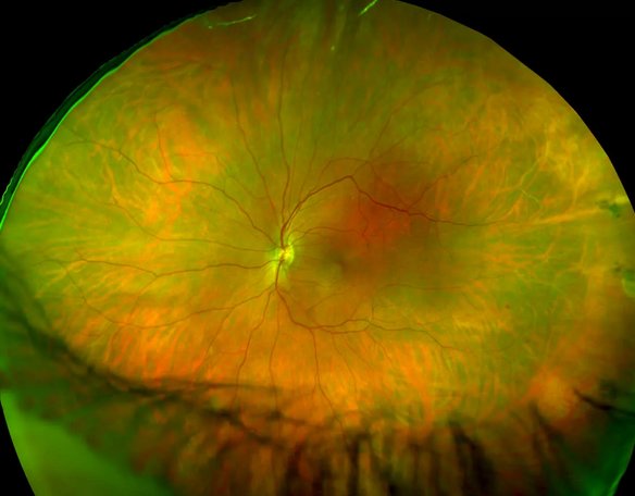 Витреохориоретинальная дистрофия сетчатки