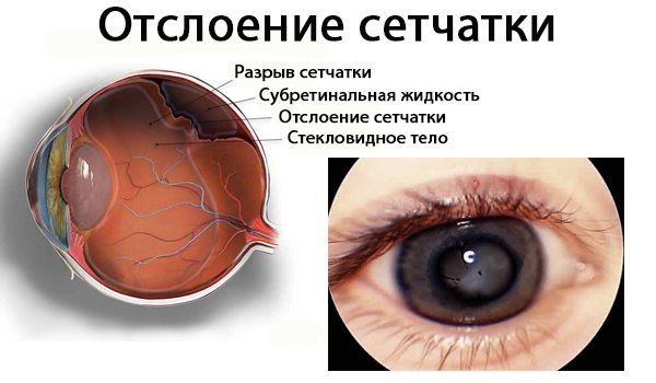 Отслойка нейроэпителия сетчатки