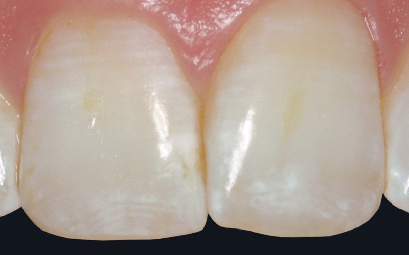 Деструкционный флюороз