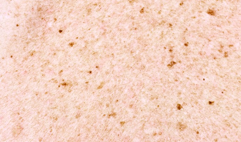 Кожа с веснушками текстура