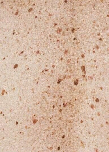 Веснушки текстура