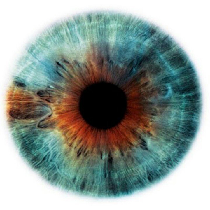 Гетерохромия радужной оболочки