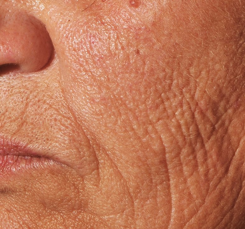 Кожа с морщинами