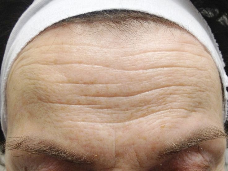 Мимические морщины на лбу