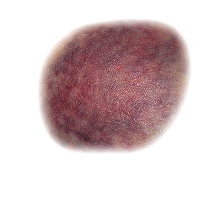 Синяк на призрачном фоне