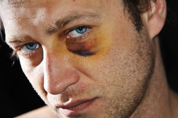 Кровоподтек под глазом