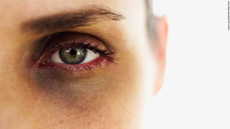 Синяки под глазами причины