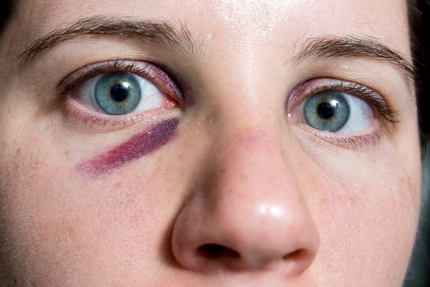 Параорбитальная гематома