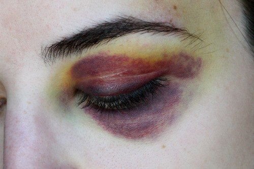 Периорбитальная гематома