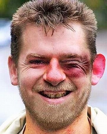 Мужик с синяком под глазом