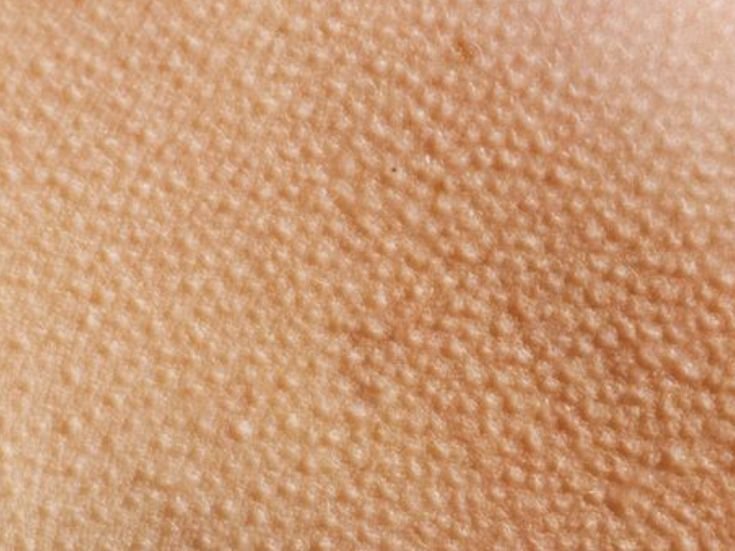Keratosis pilaris (фолликулярный гиперкератоз)