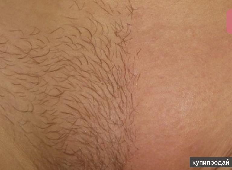 Депиляция глубокое бикини