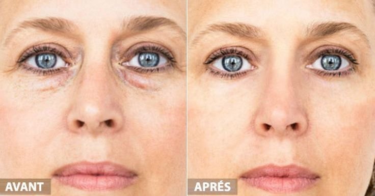 Впалые глаза и темные круги