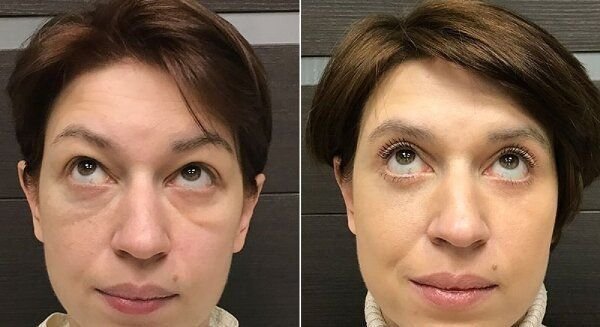Блефаропластика от малярных мешков