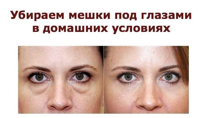 Мешки под глазами