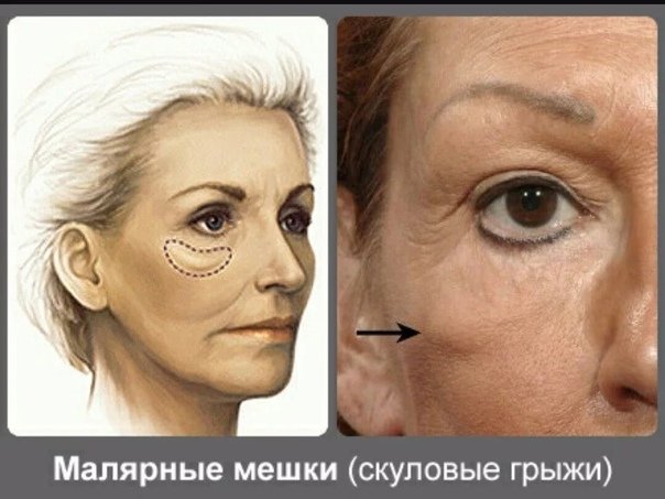 Малярные скуловые мешки