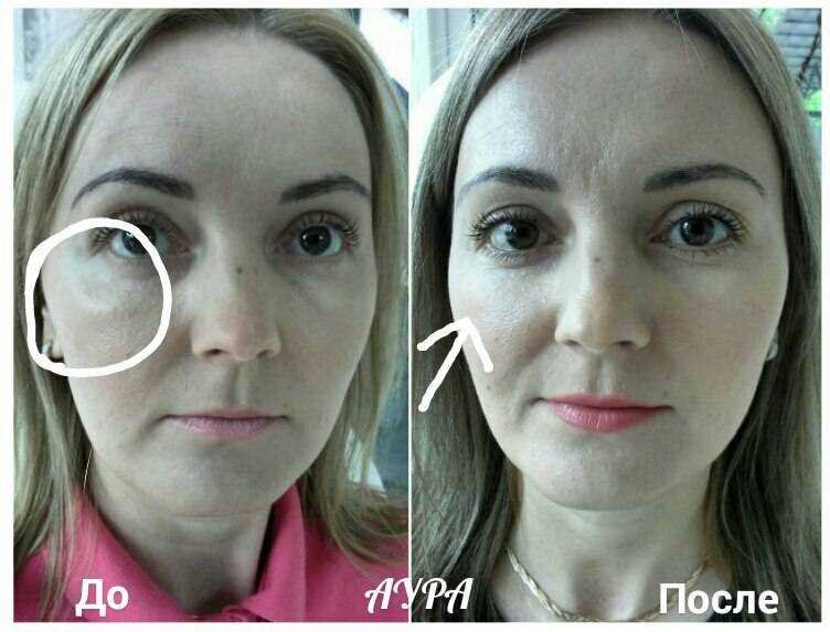 Малярный мешок слезная борозда