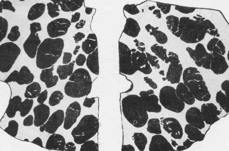 Нодулярная текстура