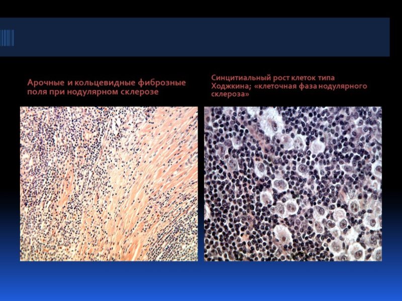 Лимфома Ходжкина нодулярный склероз