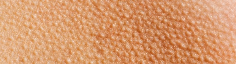 Фолликулярный гиперкератоз