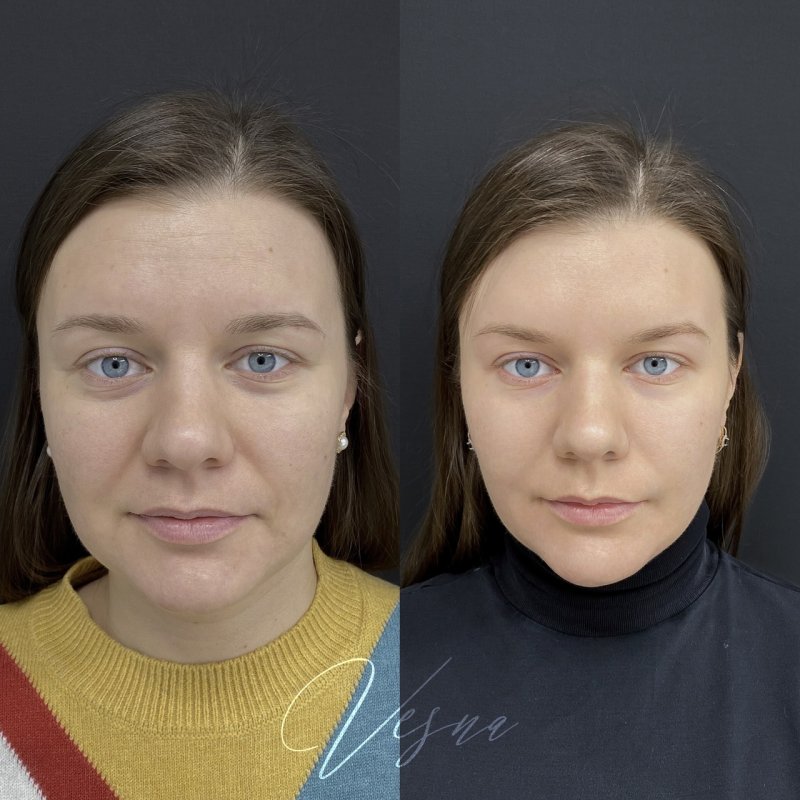 Коллагеностимуляция Результаты