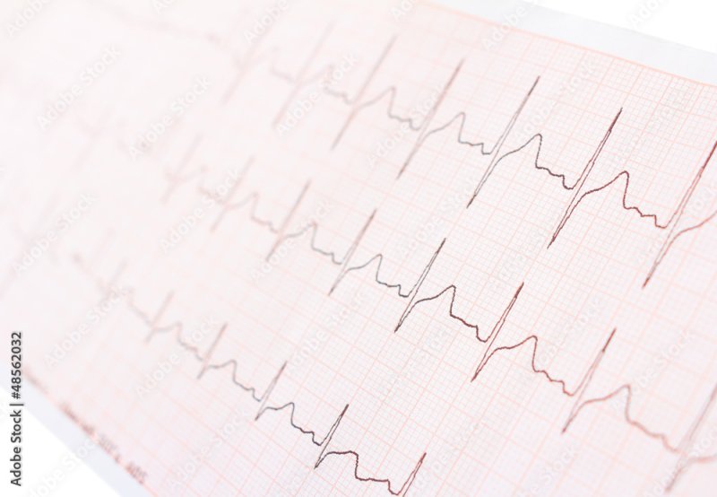 ЭКГ фон