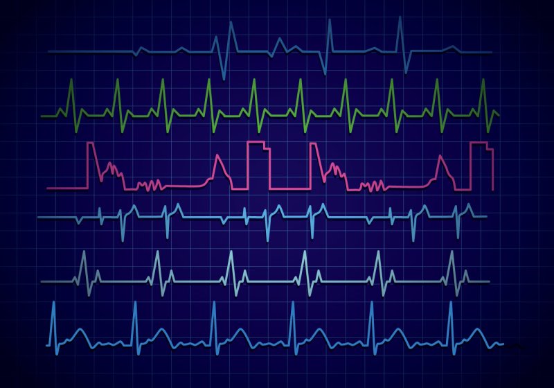 ЭКГ фон