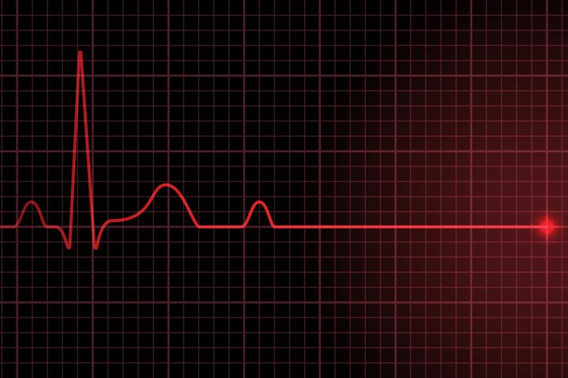 Пульс остановка сердца