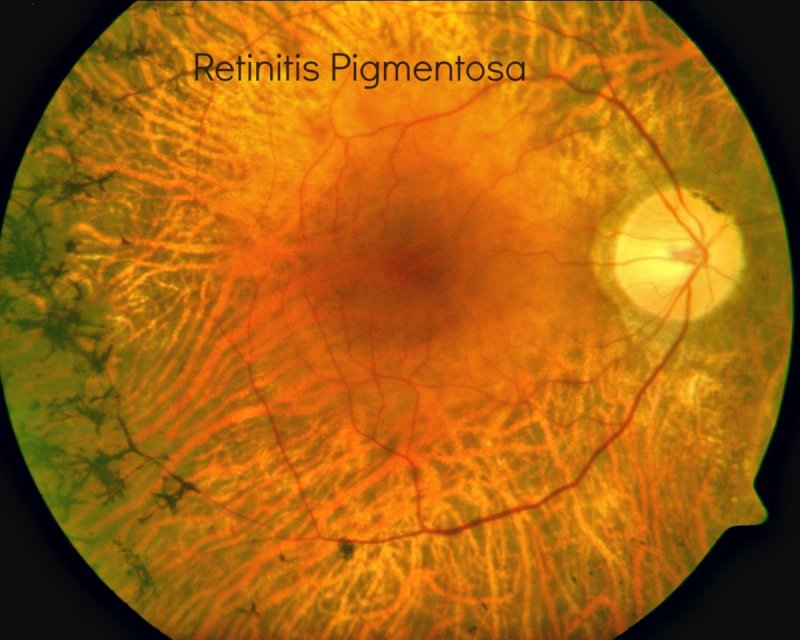 Ретинит (пигментная дистрофия сетчатки)