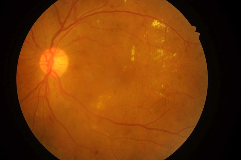 Макулярная дистрофия сетчатки глаза