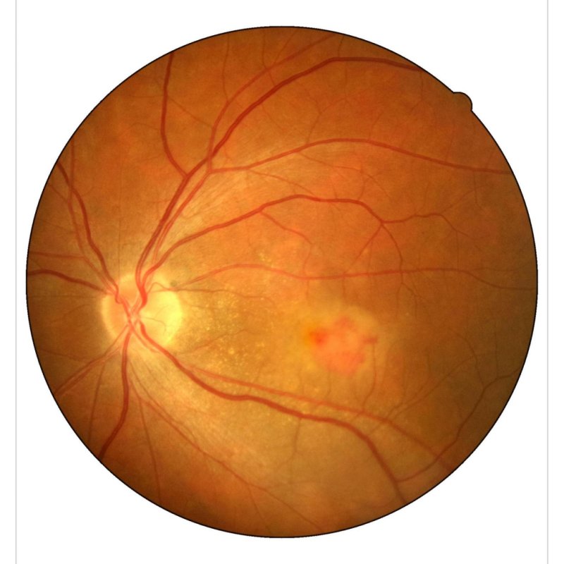 Макула дистрофия сетчатки