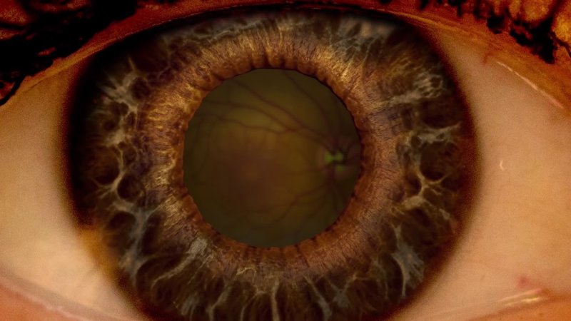 Макулодистрофия, макулярная дегенерация