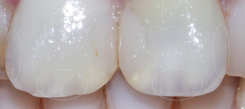 Отбелы зуботехника