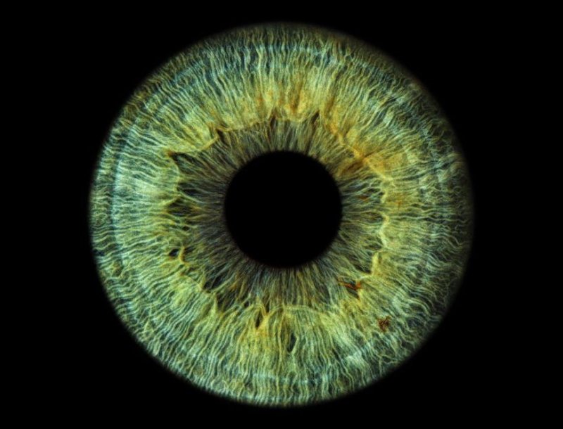 Гетерохромия радужной оболочки