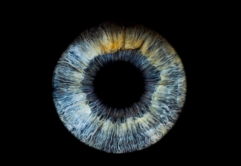 Гетерохромия радужной оболочки