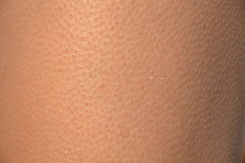 Гиперкератоз гусиная кожа