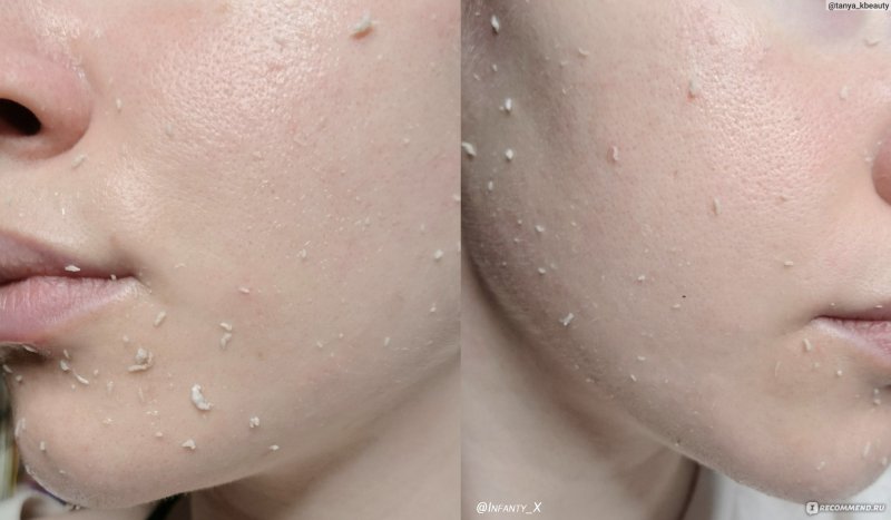 Пилинг скатка с углем