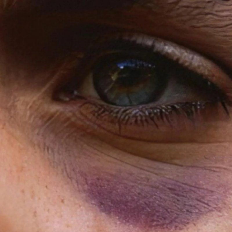 Кровоподтек под глазом