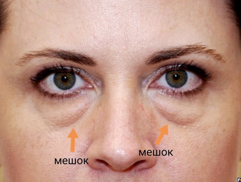 Мешки и синяки под глазами