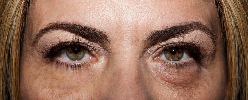 Потемнение вокруг глаз