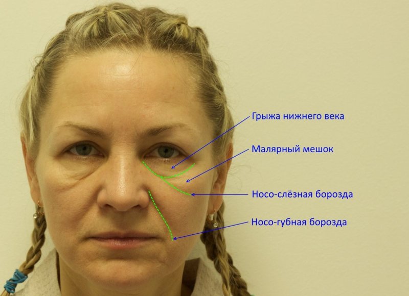 Малярные мешки под глазами