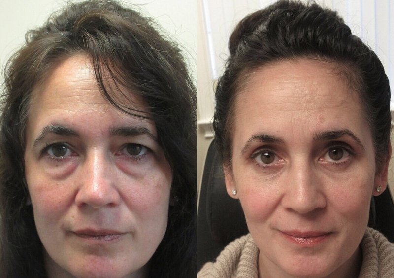 Мооярные мешочки под глазами