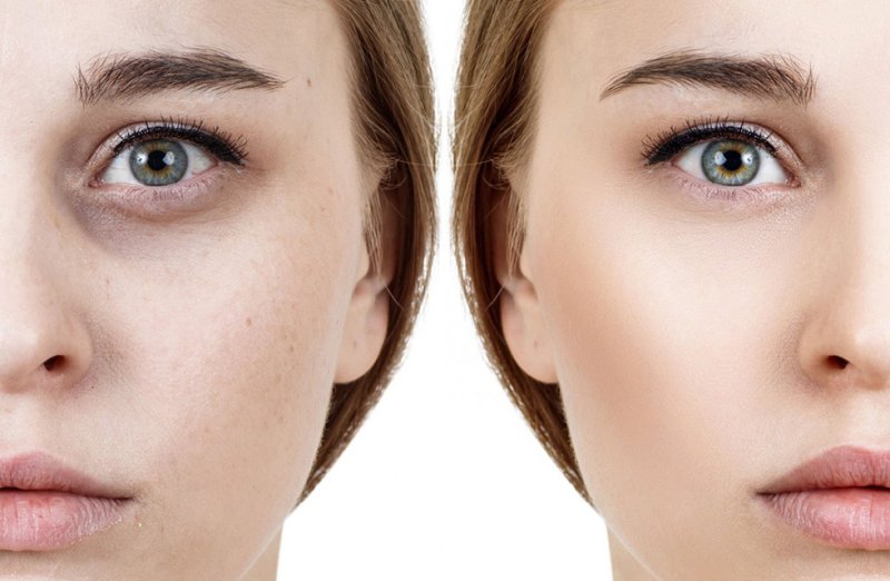 Темные мешки под глазами