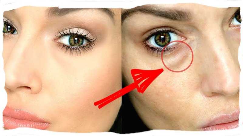 Мешки под глазами