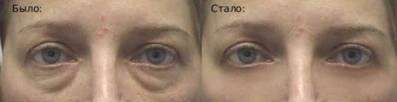 Отечные мешки под глазами