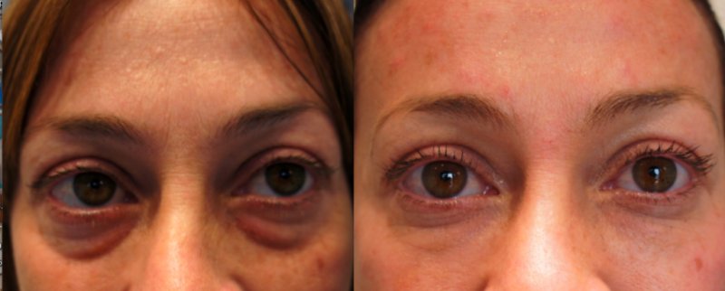 Мешки под глазами