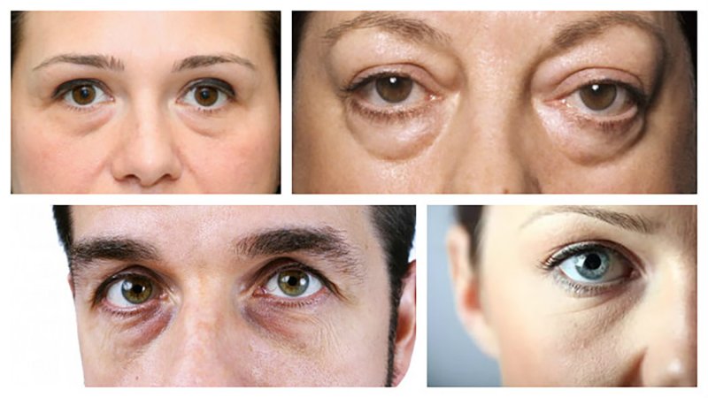 Мешки под глазами